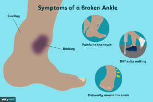 trimalleolar ankle fracture recovery