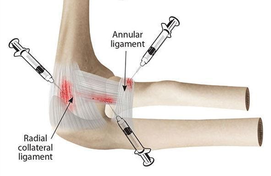 prevention-of-hand-elbow-treatment-injection