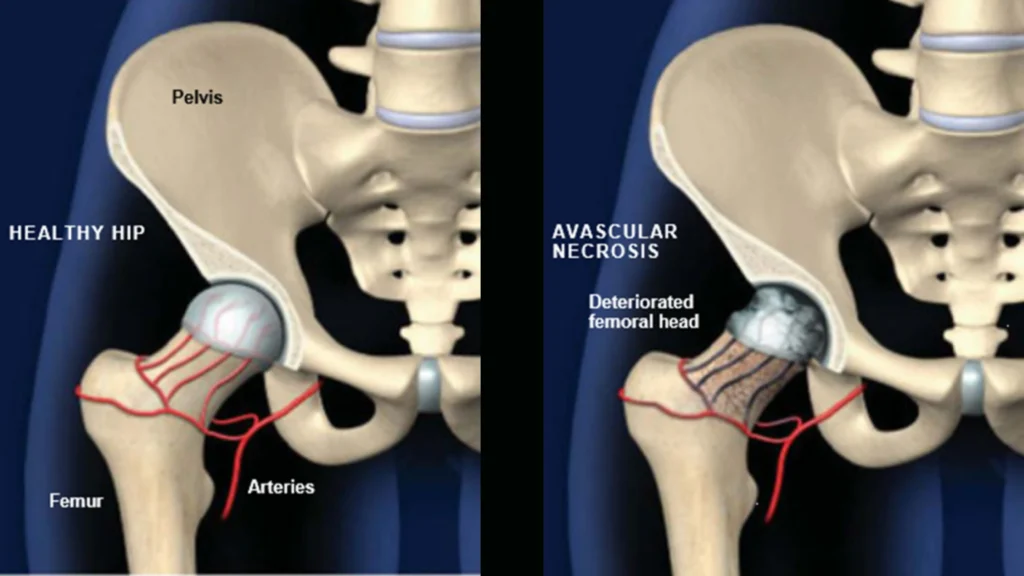 Anatomical Graphic of Avascular Necrosis