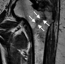 X-ray view of a hip fracture diagnosis
