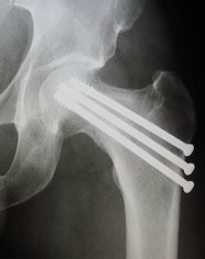 X-ray view of the treatment for femoral neck fractures