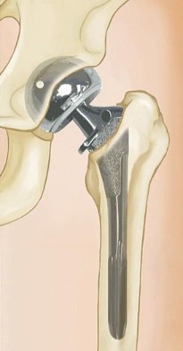 Graphic for displaced femoral neck treatment