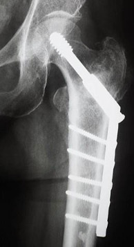 X-ray view of the fix for intertrochanteric hip fractures with a compression screw and side plate
