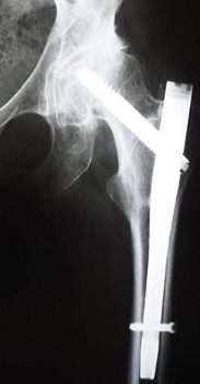 X-ray view of the fix for intertrochanteric hip fractures with a Intramedullary Nail
