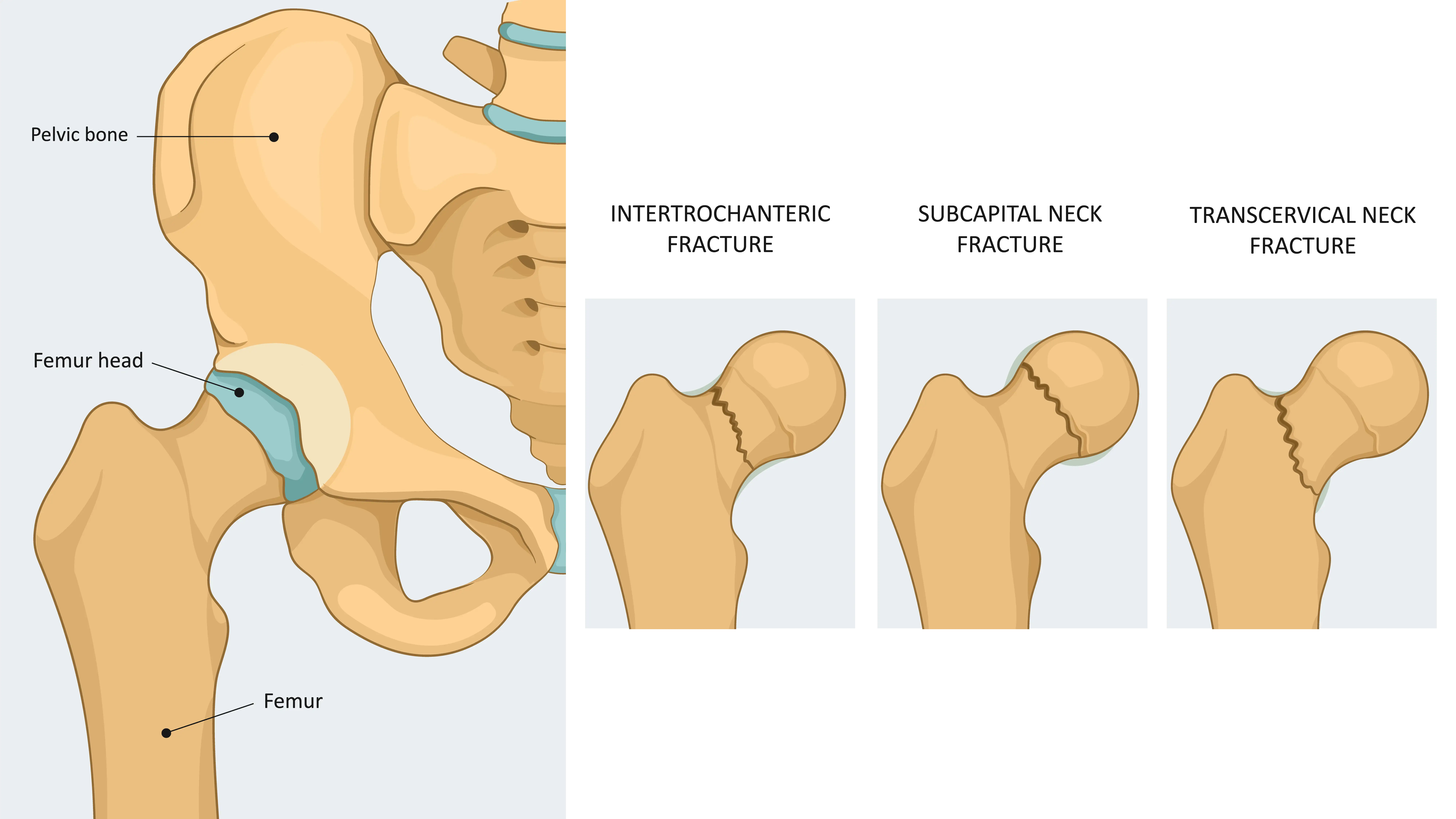 Hip Fracture Anatomy