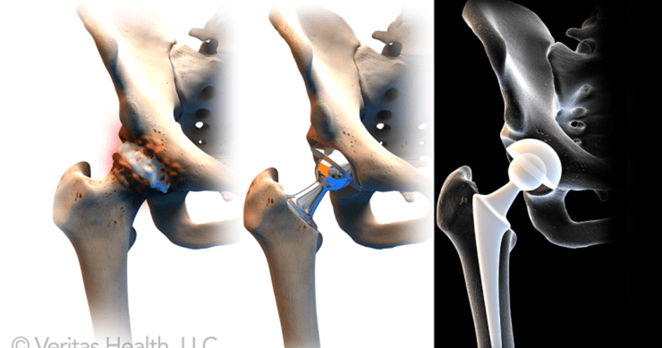 Advantages and Disadvantages of total hip replacement anterior approach