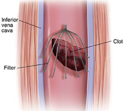 Treatment for blood clots