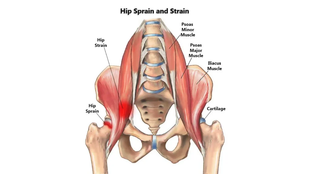 Anatomical Graphic of Hip Strain