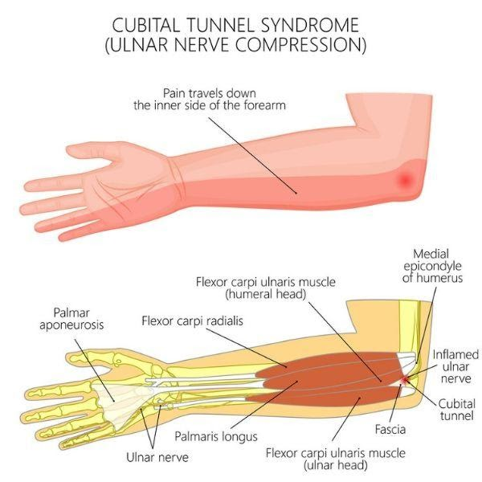 Causes of Ulnar Nerve Pain