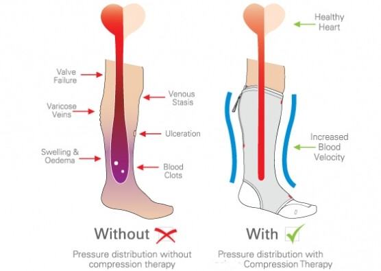Diagram of patient with and without Compression Therapy