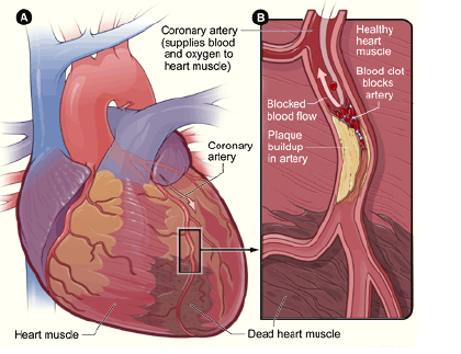 Heart muscle diagram graphic comparing a living and dead heart muscle