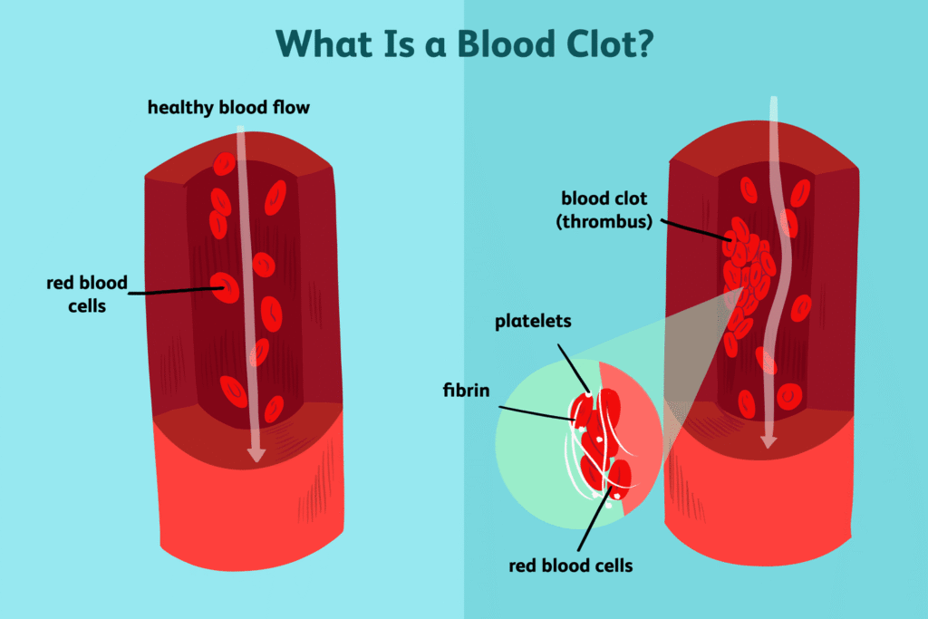 Overview of Blood Clots