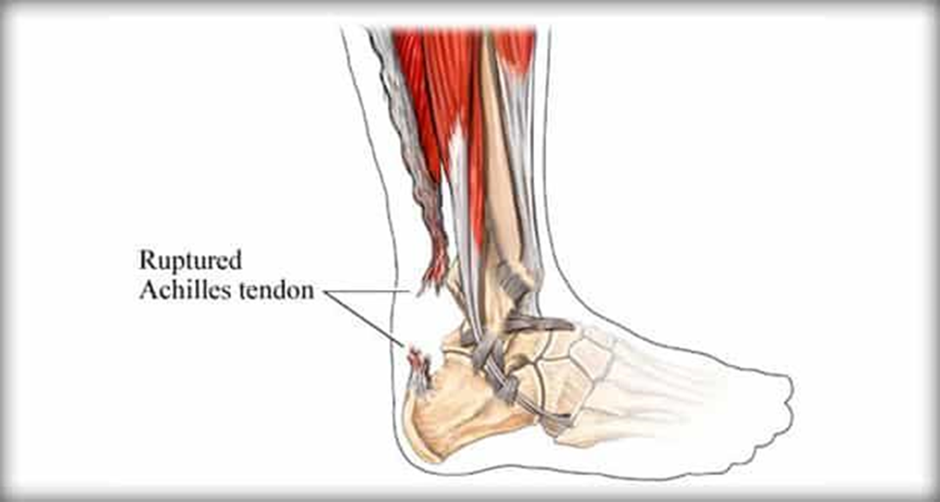 Diagram of ruptured achilles tendon