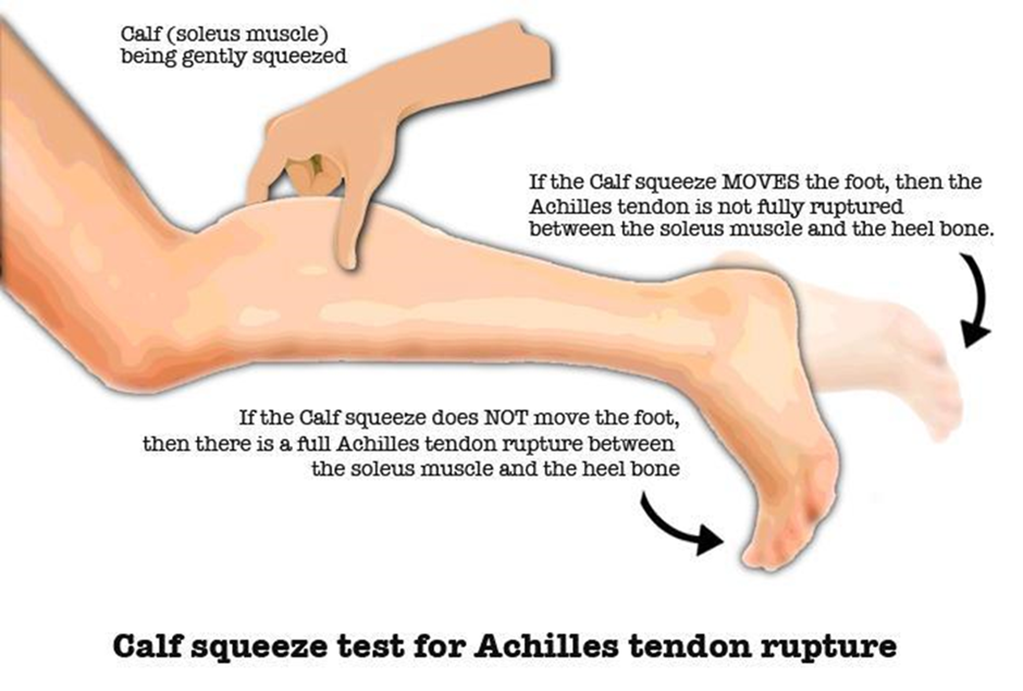 Calf squeeze test instructions for Achilles tendon rupture