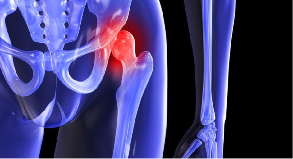 Hip osteoarthritis x-ray view