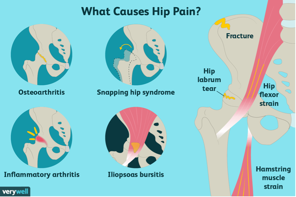 What causes hip pain graphic including diagram of hip and pain points