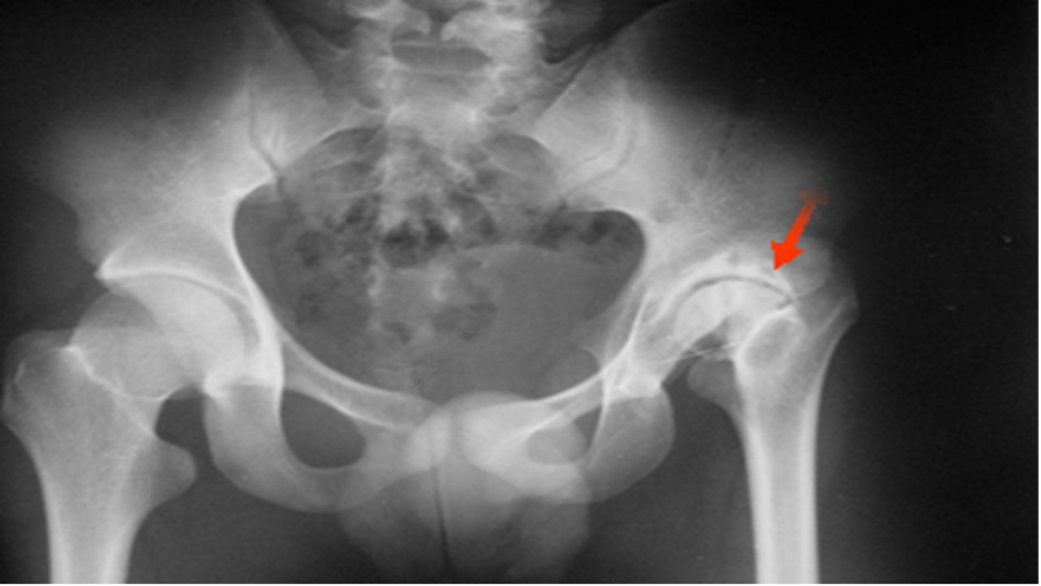 X-ray view of Osteoarthritis of the hip