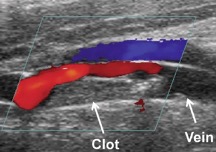 X-ray view of blood clot and vein