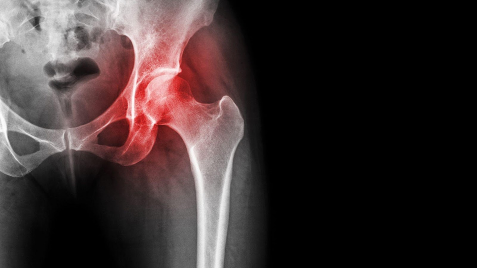 Osteonecrosis of the Hip