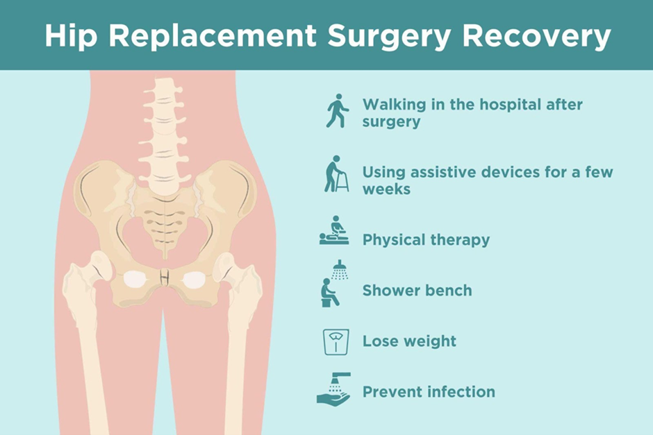 Post Operative Care of Total Hip Replacement Surgery Anterior Approach
