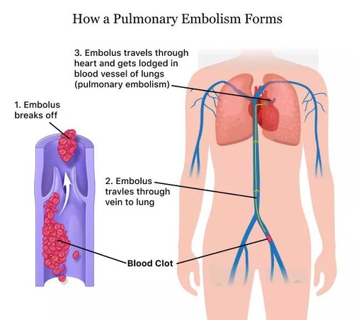 Pulmonary Embolism Formation