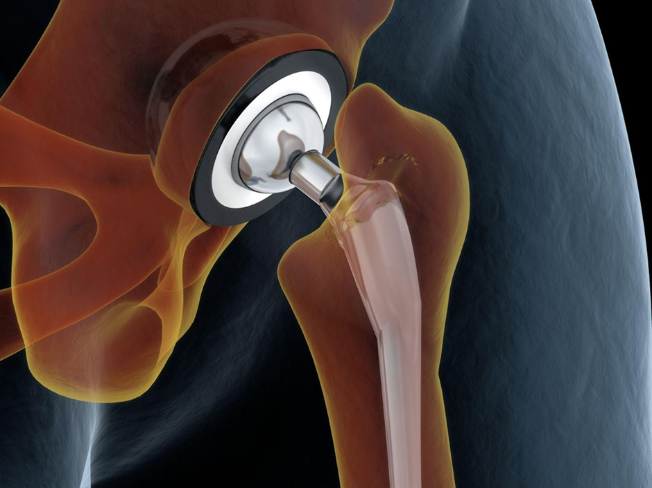 Total Hip Replacement – Anterior Approach
