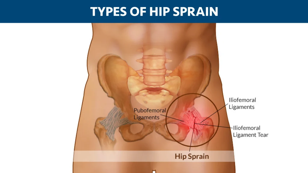 TYPES OF HIP STRAINS