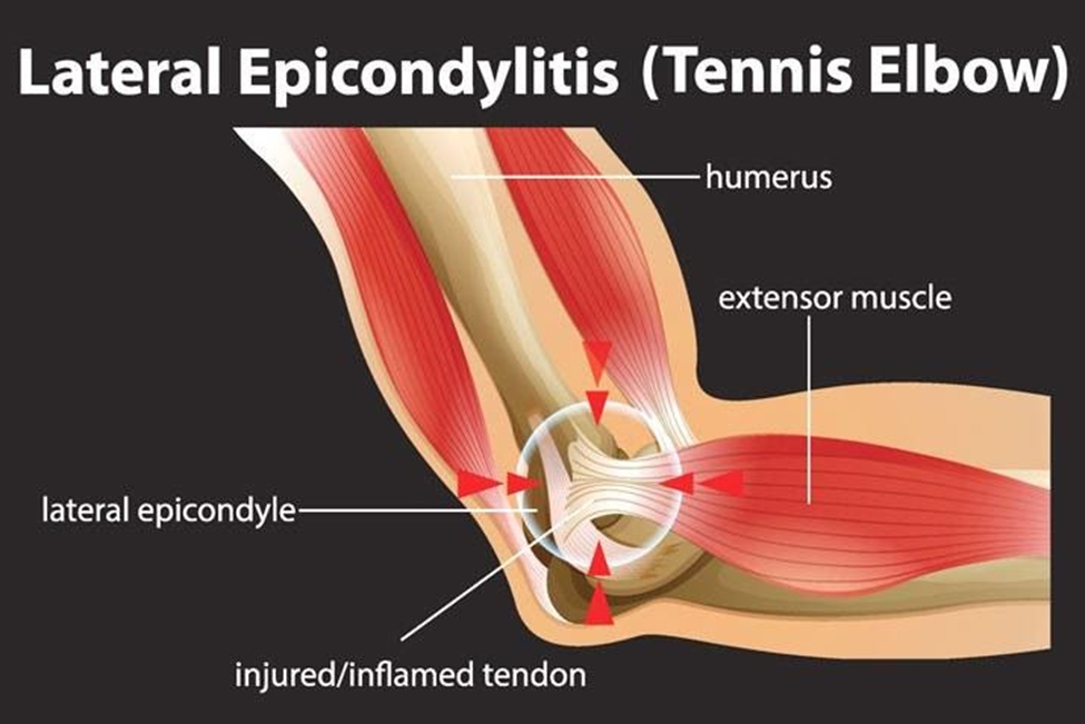 Anatomical graphic of tennis elbow