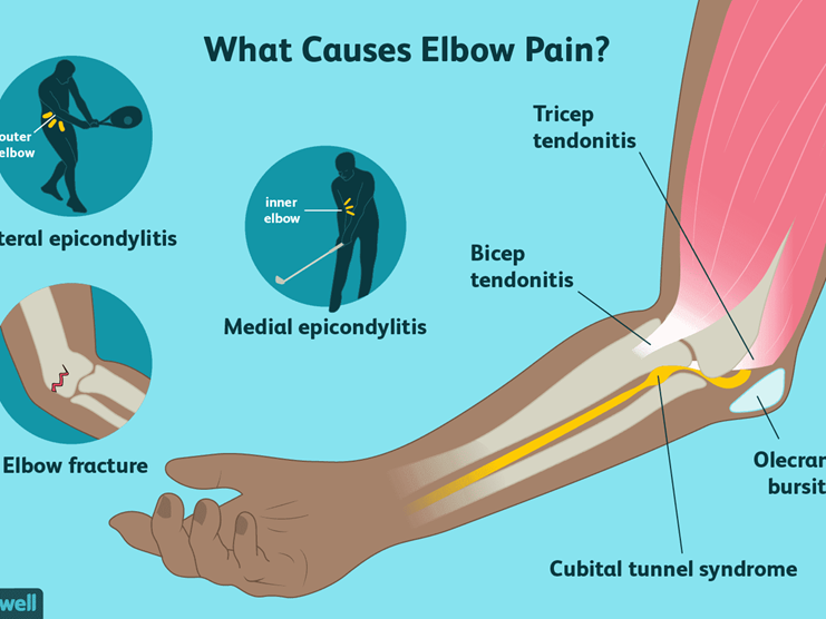 Causes of Tennis Elbow