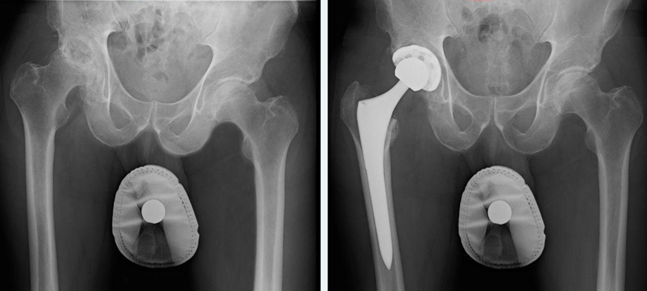 X-Ray view of a hip before and after total hip replacement from the anterior approach