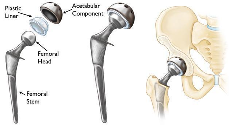 Technology used in a total hip replacement procedure
