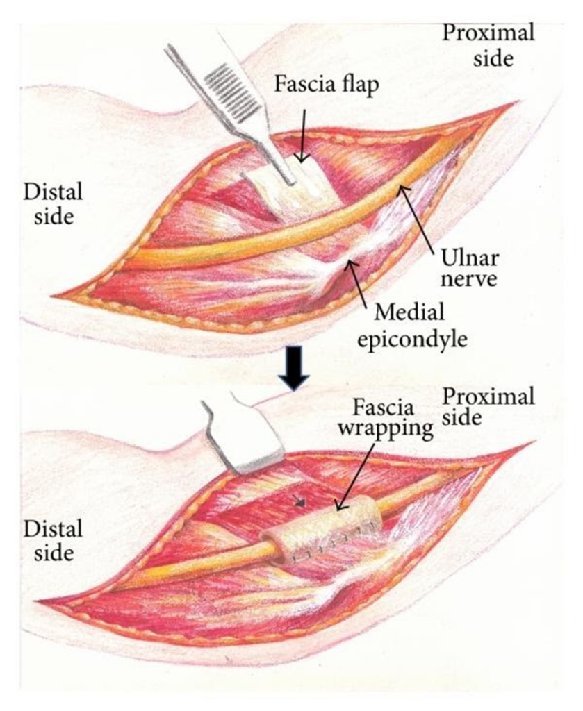 Anatomical Graphic of Ulnar Nerve