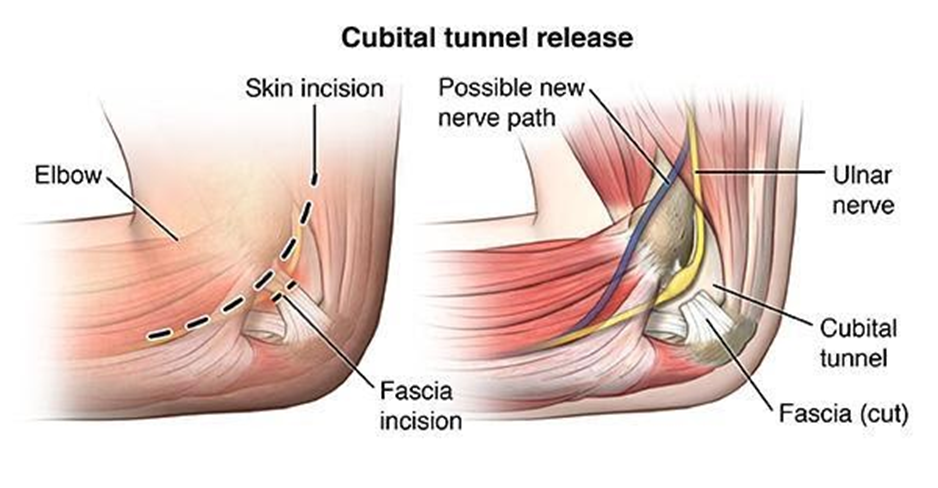 Anatomical Graphic of Cubital Tunnel Release