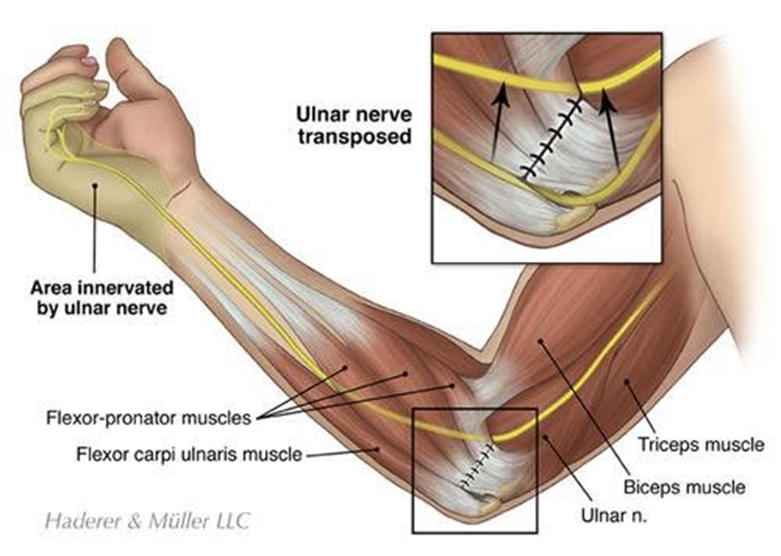 Anatomical graphic of the ulnar nerve detailed
