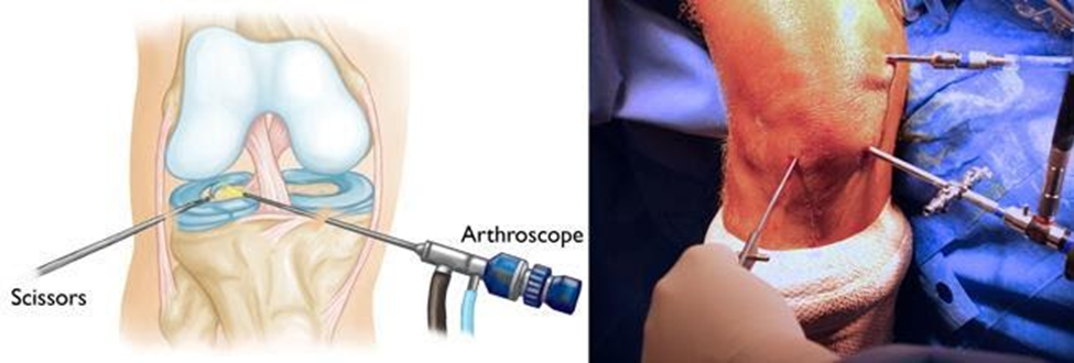 Anatomical and photo of Arthroscopic Knee Surgery