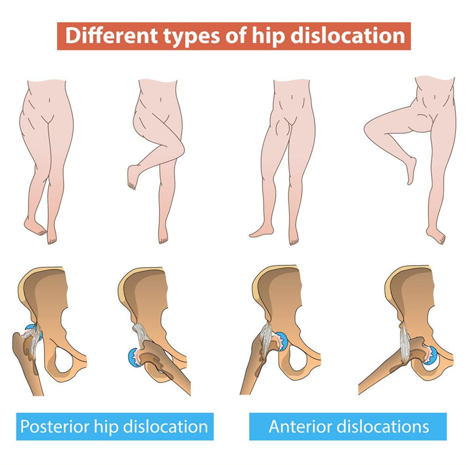 Different types of hip dislocation