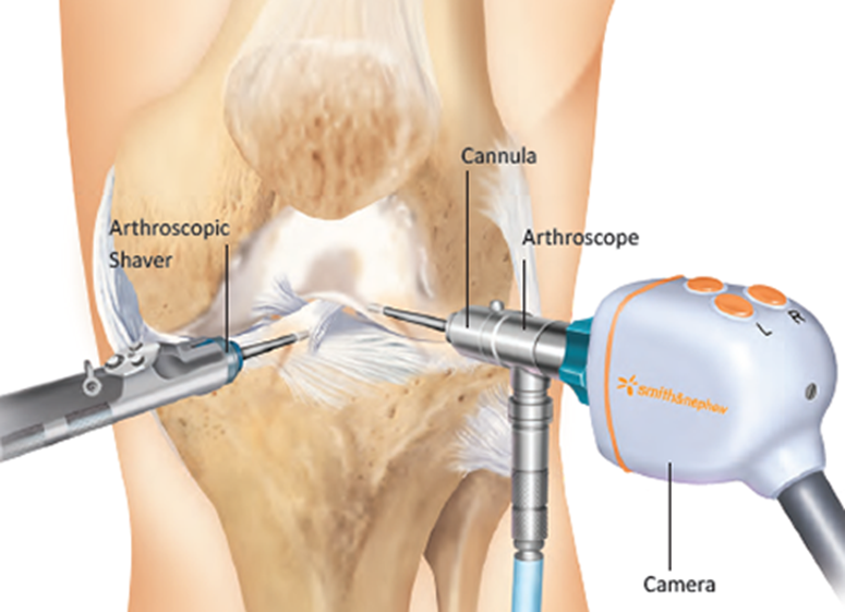 Anatomical graphic of Arthroscopic process