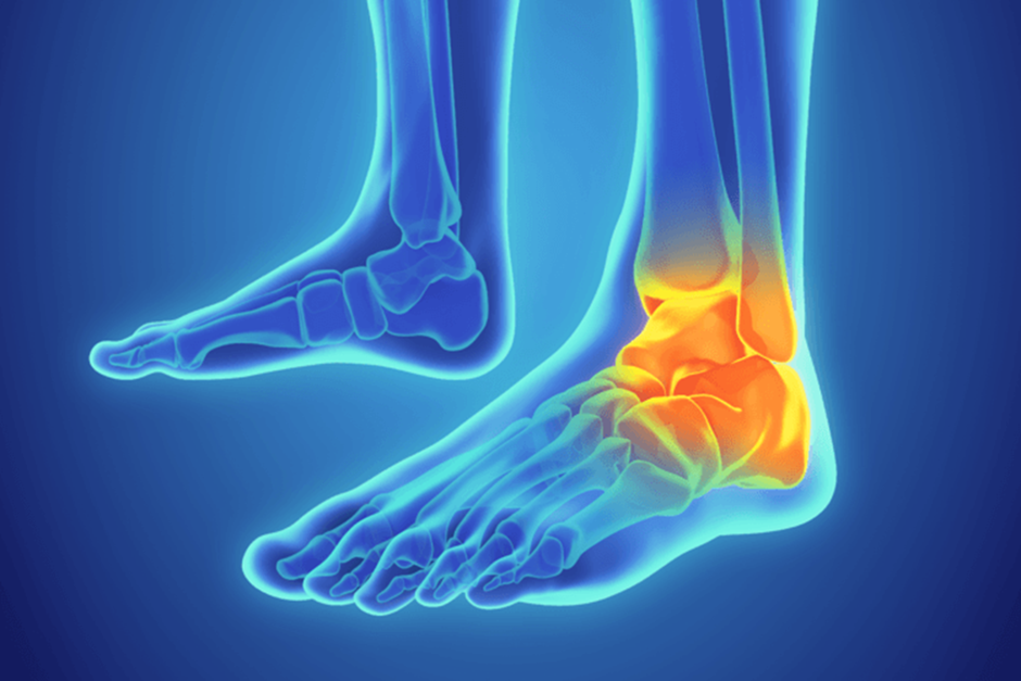 Ankle Sprain