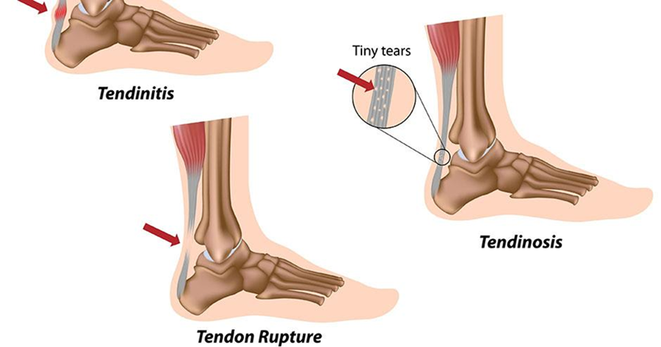 Achilles tendon rupture, tendinosis, and tendinitis