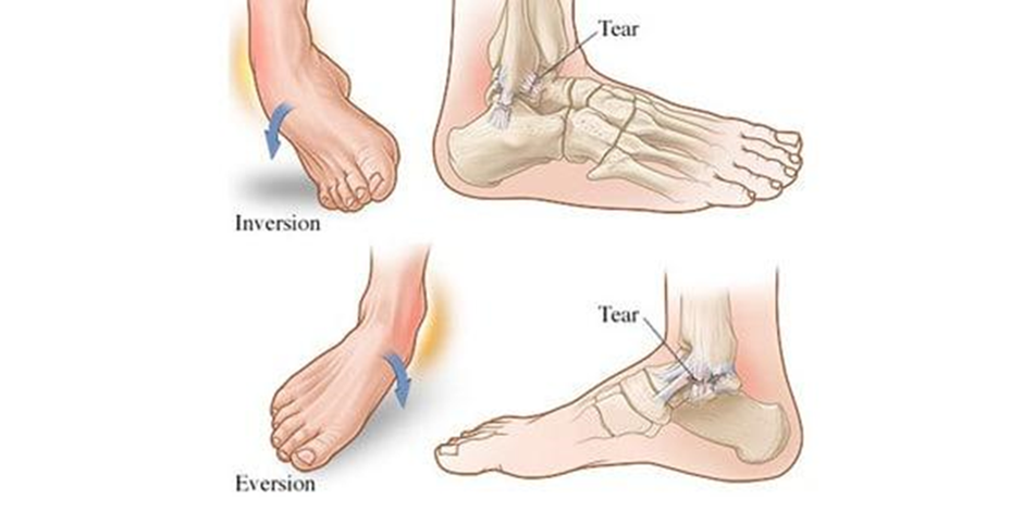 Types of Ankle Sprain
