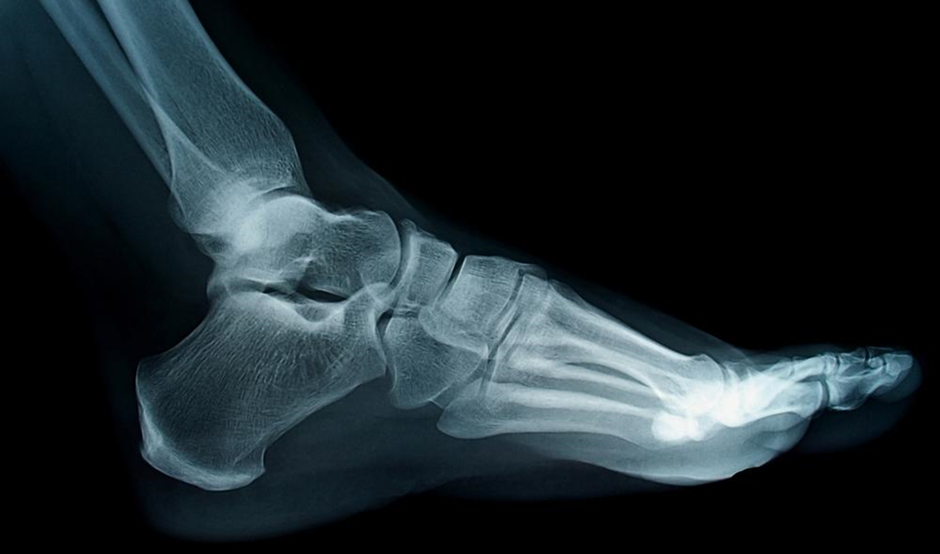 Ankle Sprain diagnosis X-ray