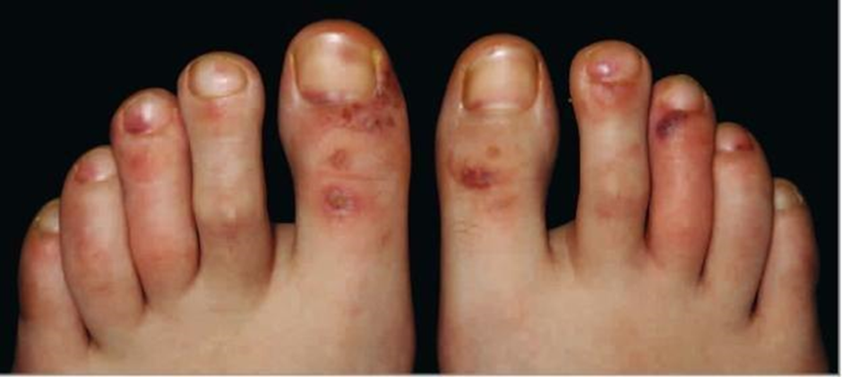 Common Toe Deformities