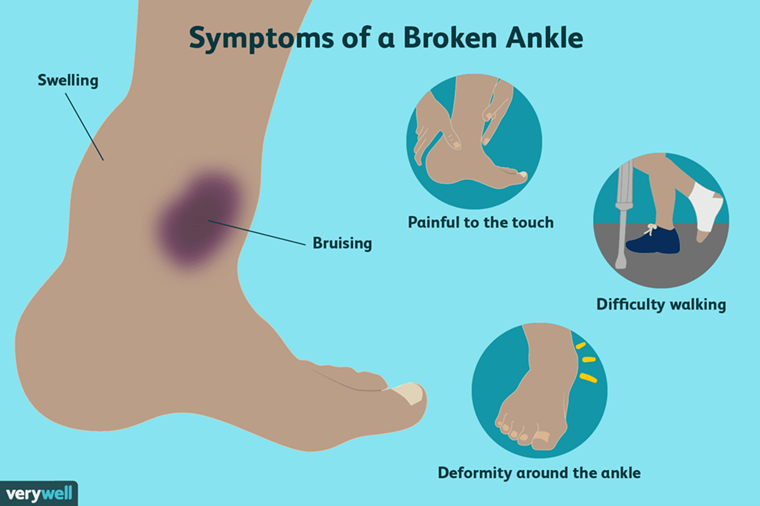 The symptoms of a broken ankle