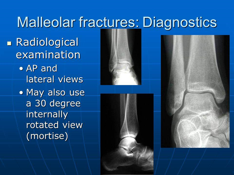 Diagnostics of a Malleolar Fractures 