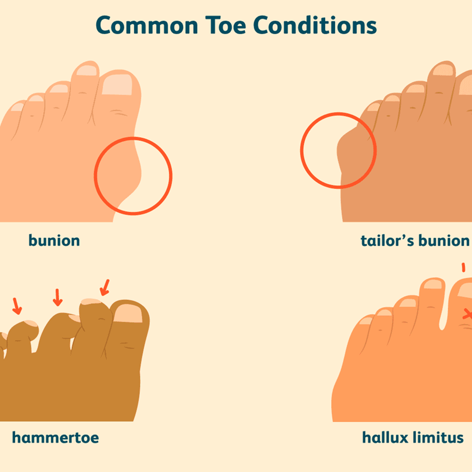 Anatomical Graphic of Common Toe Conditions