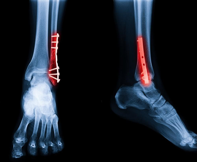 Ankle Fracture Surgery