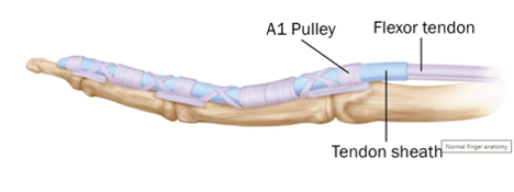 Anatomical graphic of trigger finger