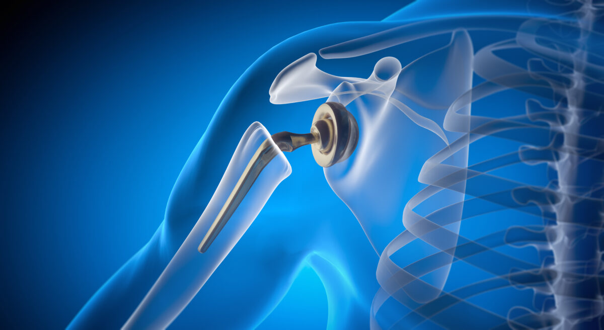 Shoulder replacement technology