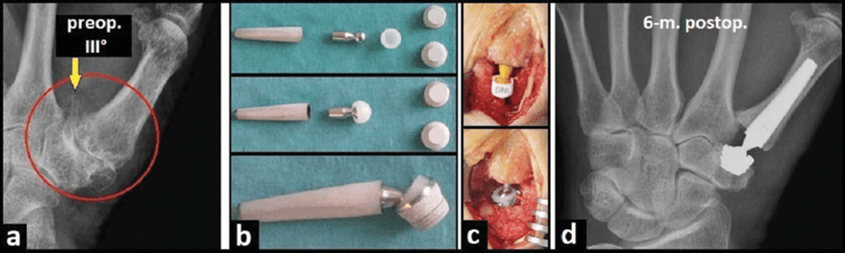 X-rays and joint replacement product implants