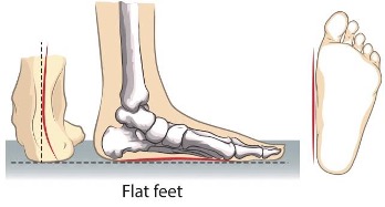 Plantar Fasciitis – Risk Factors